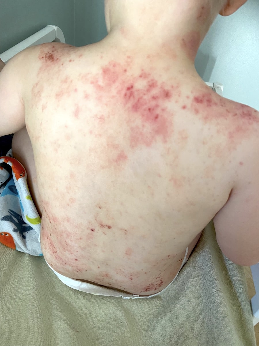 childhood eczema on back and neck