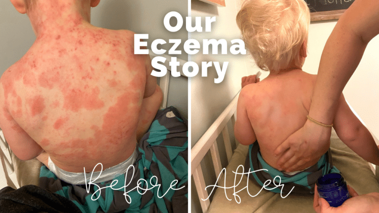 Ozonated Olive Oil for Eczema – Before and After