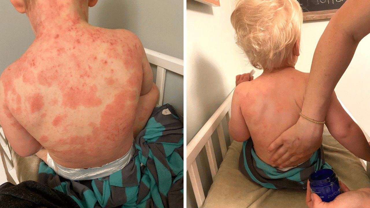 ozonated olive oil on eczema before and after