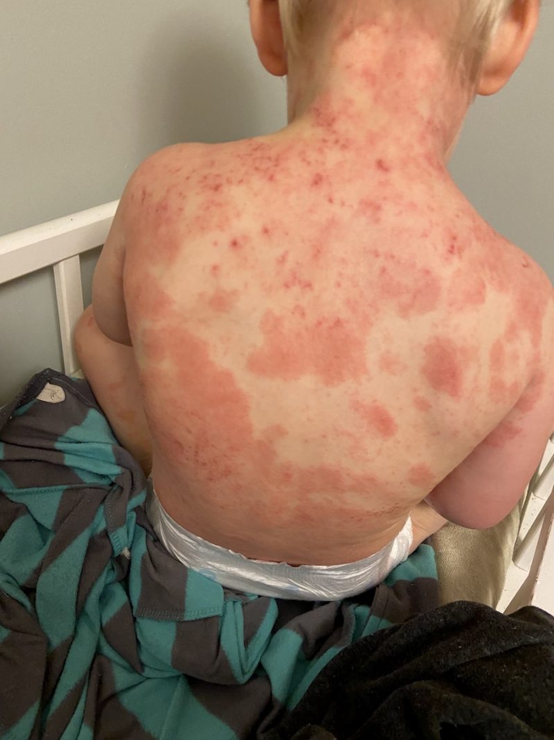 Ozonated Olive Oil for Eczema Before and After From Scratch Farmstead