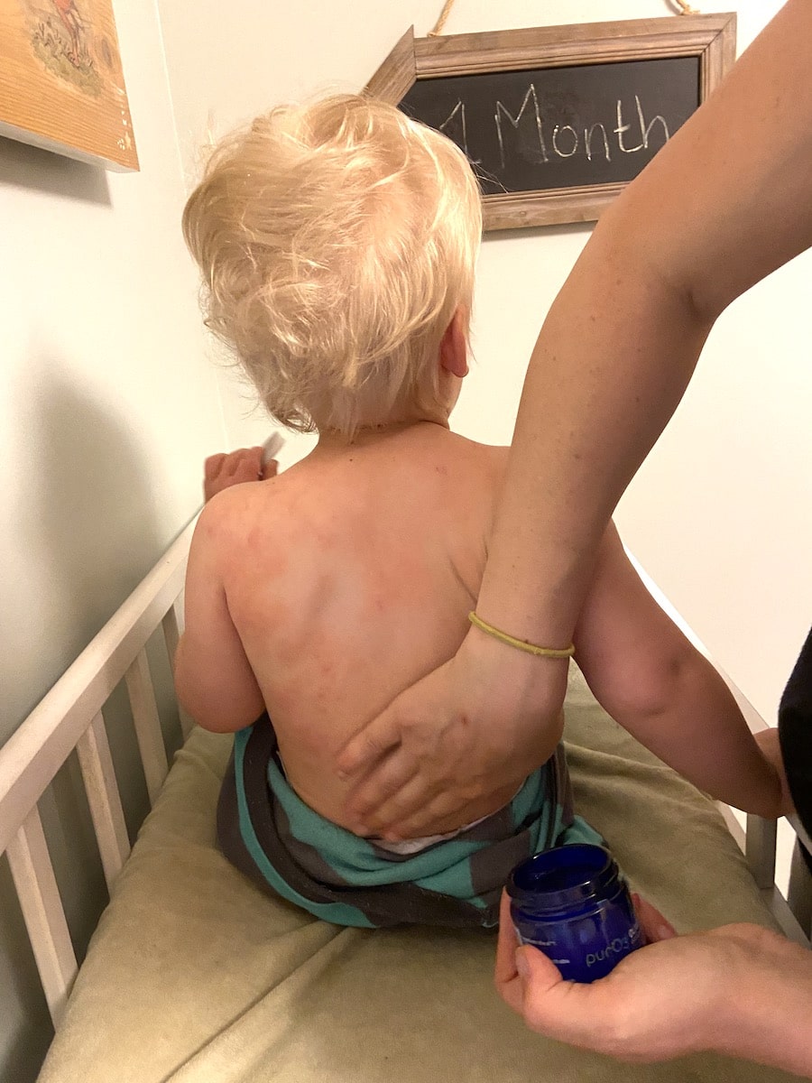 using ozonated olive oil on child with eczema